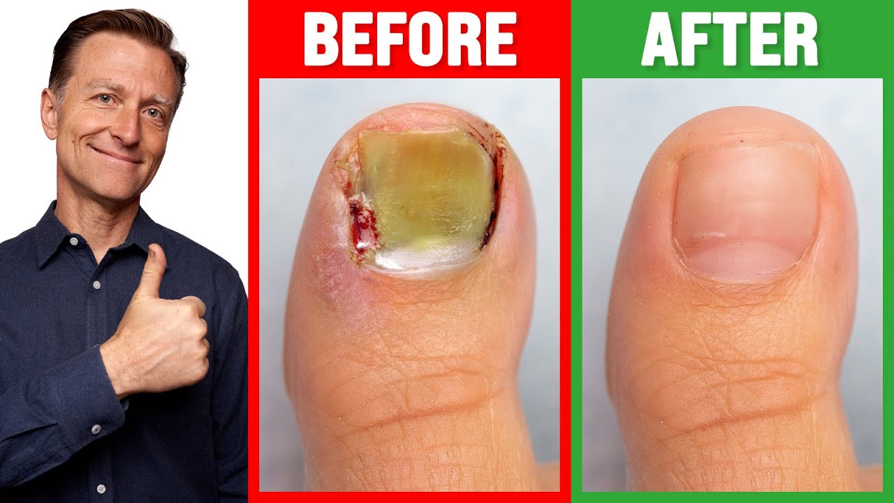 Get Rid of Unsightly Fungal Toenails | Same Day Appointment