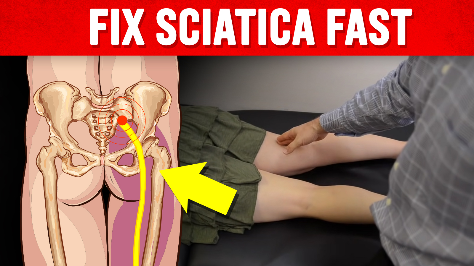 The Ultimate Guide to Sciatica 2024: How can I permanently fix nerve pain?