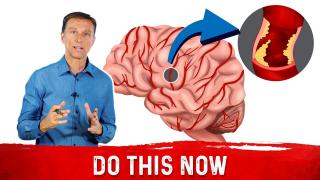 How To Avoid A Silent Stroke | Healthy Keto™ Dr. Berg