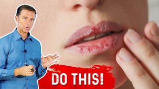 How to Fix Your Chapped Lips | Healthy Keto™ Dr. Berg