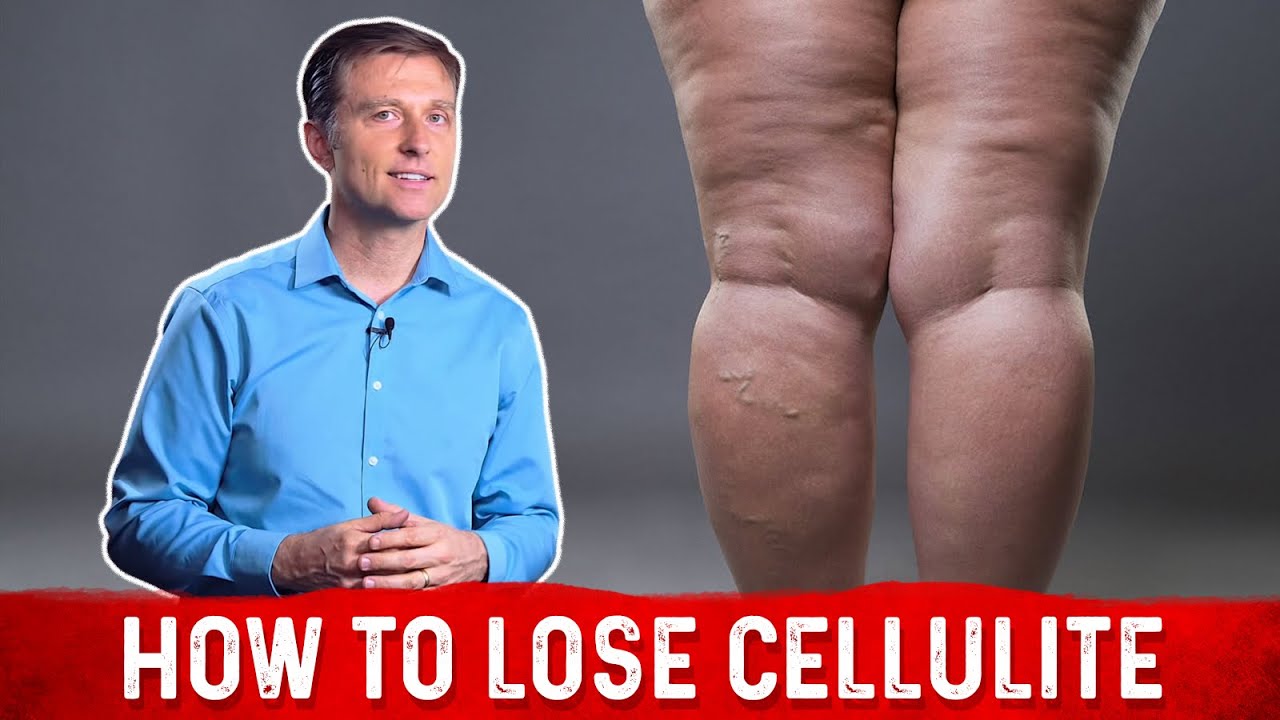 How To Get Rid Of Cellulite For Good, Natural Ways To Try
