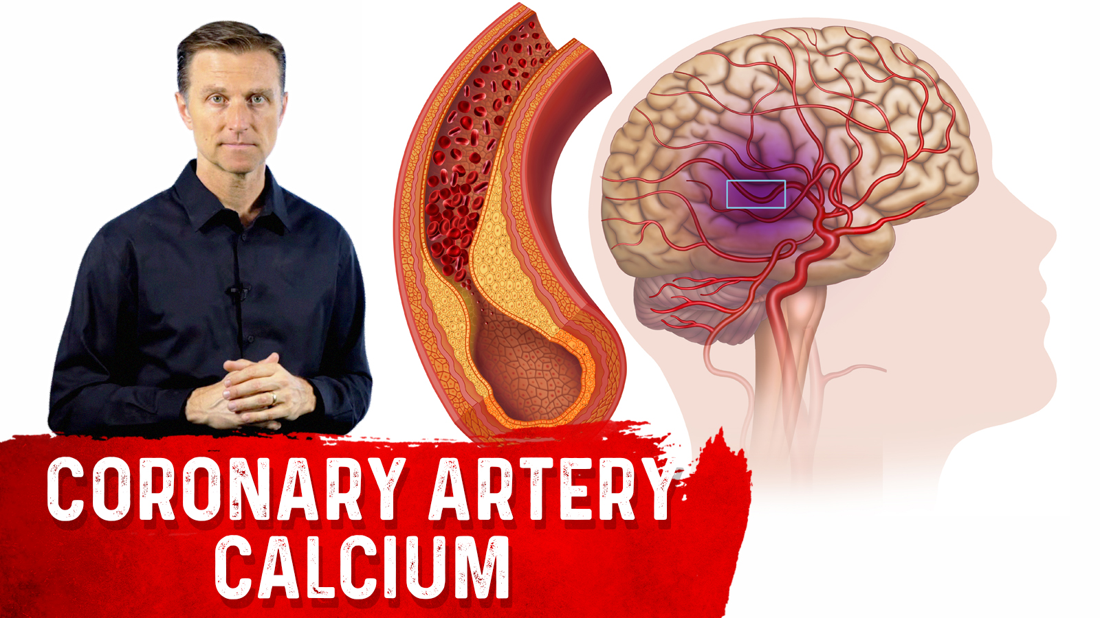 How to Read a (CAC) Score Healthy Keto™ Dr. Berg