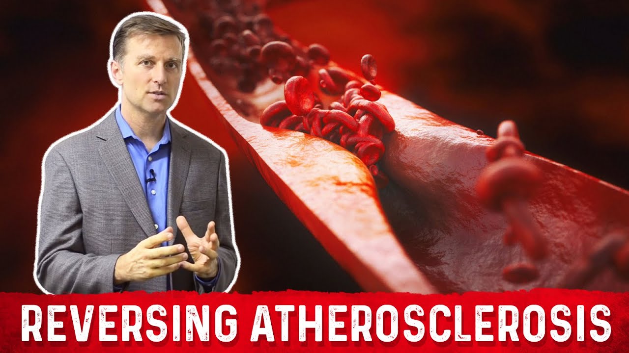 how-to-reverse-hardening-of-the-arteries-atherosclerosis-dr-berg