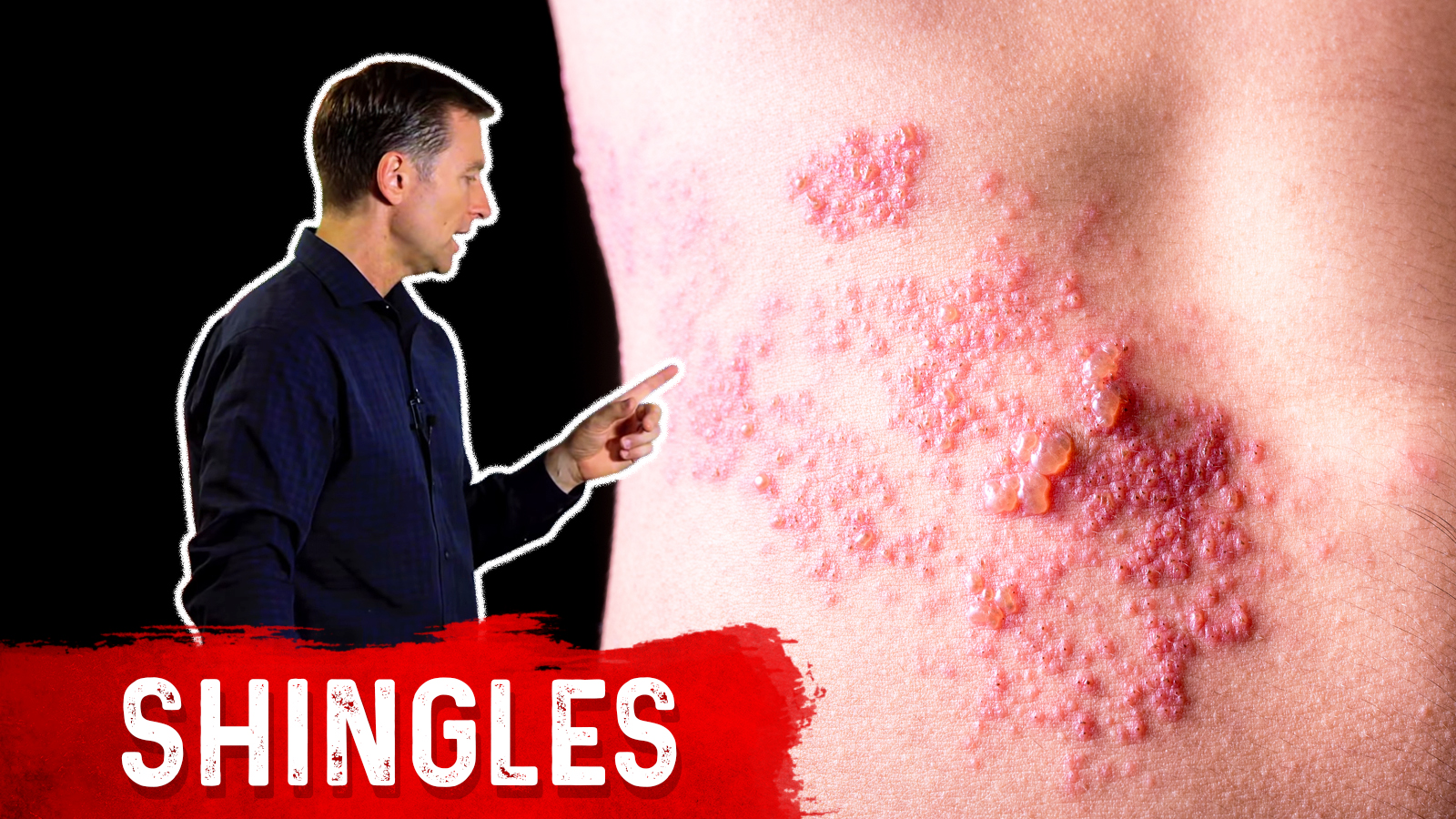 Shingles Natural Relief Healthy Keto™ Dr. Berg