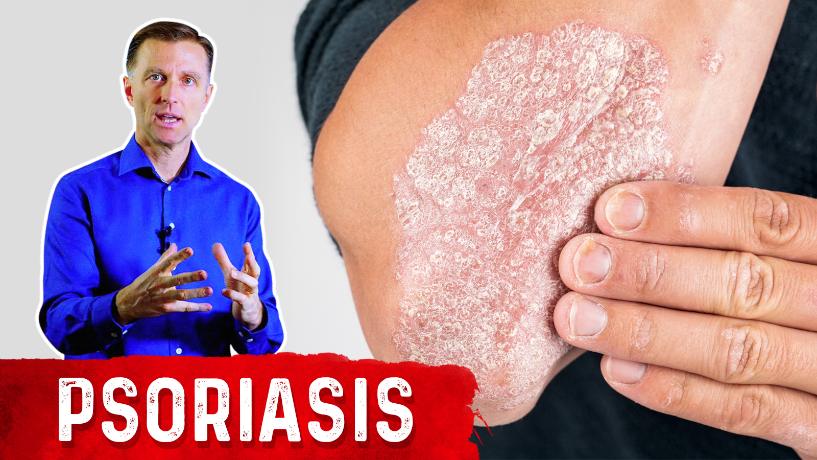 The Best 3 Remedies for Psoriasis | Healthy Keto™ Dr. Berg