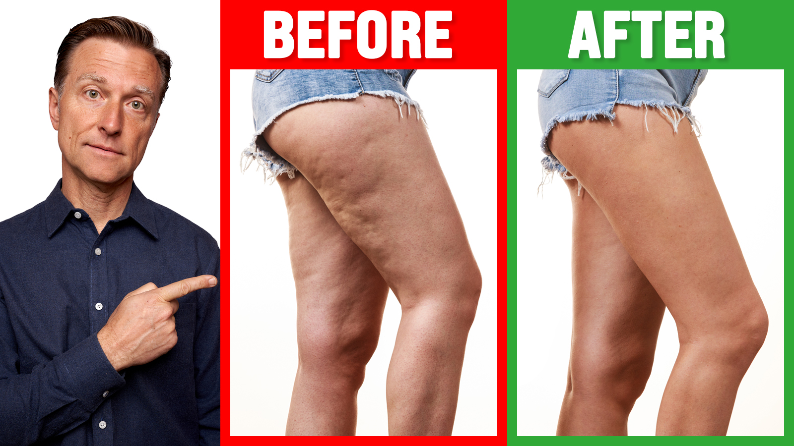 BEST Way to Lose Cellulite on Your Hips, Thighs and Buttocks
