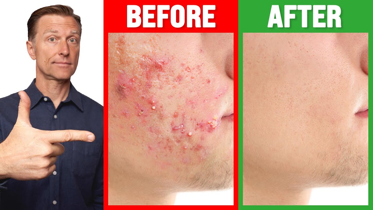 The Fastest Way To Rid Acne Healthy Keto™ Dr Berg