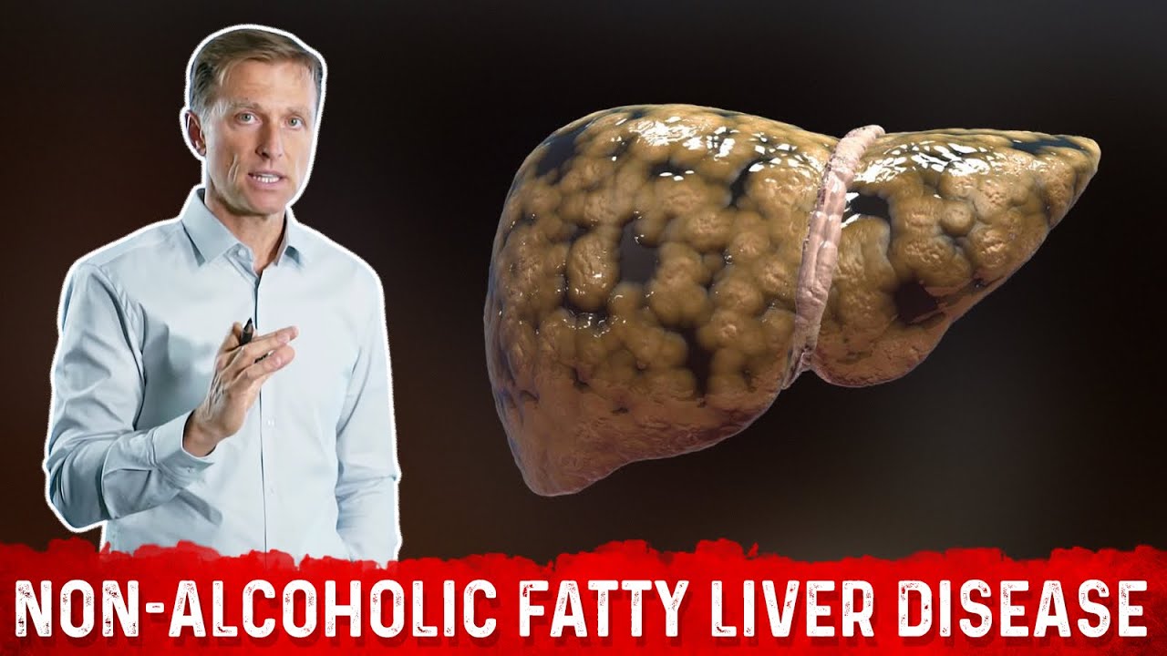 The REAL Cause of Non Alcoholic Fatty Liver Disease