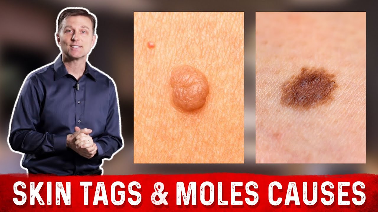 Blog Thumbnail What Causes Skin Tags And Moles 