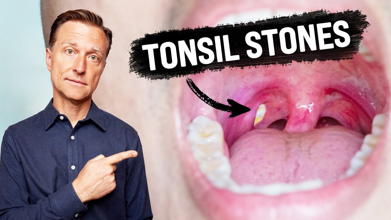 tonsils stones