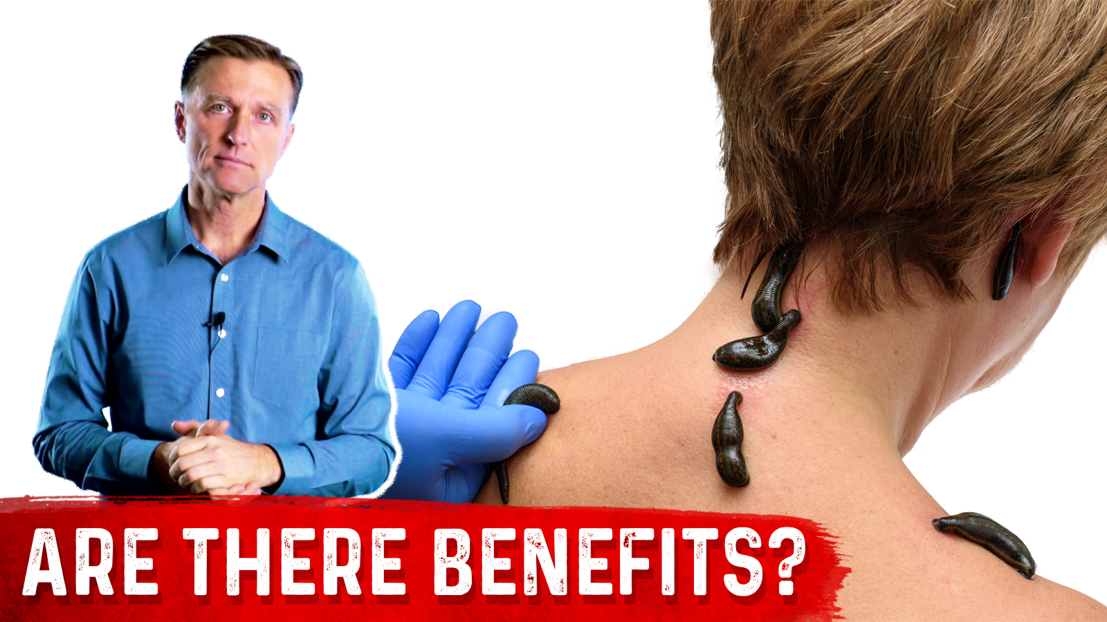 What is Leech Therapy? Healthy Keto™ Dr. Berg