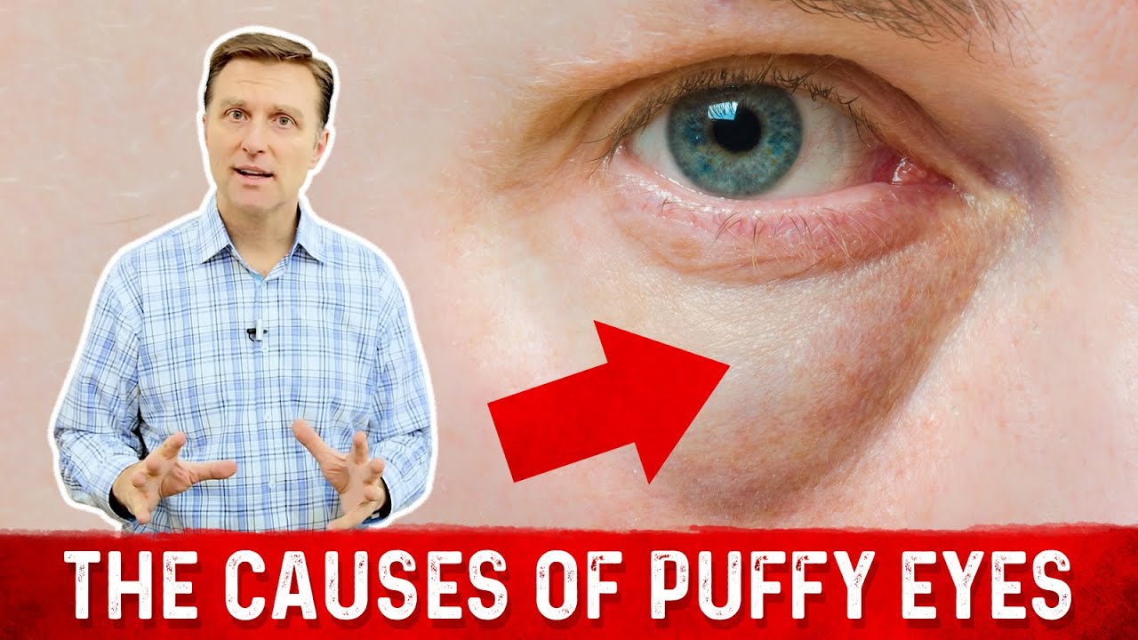 Puffy Eyes: What Causes Them and What To Do About It