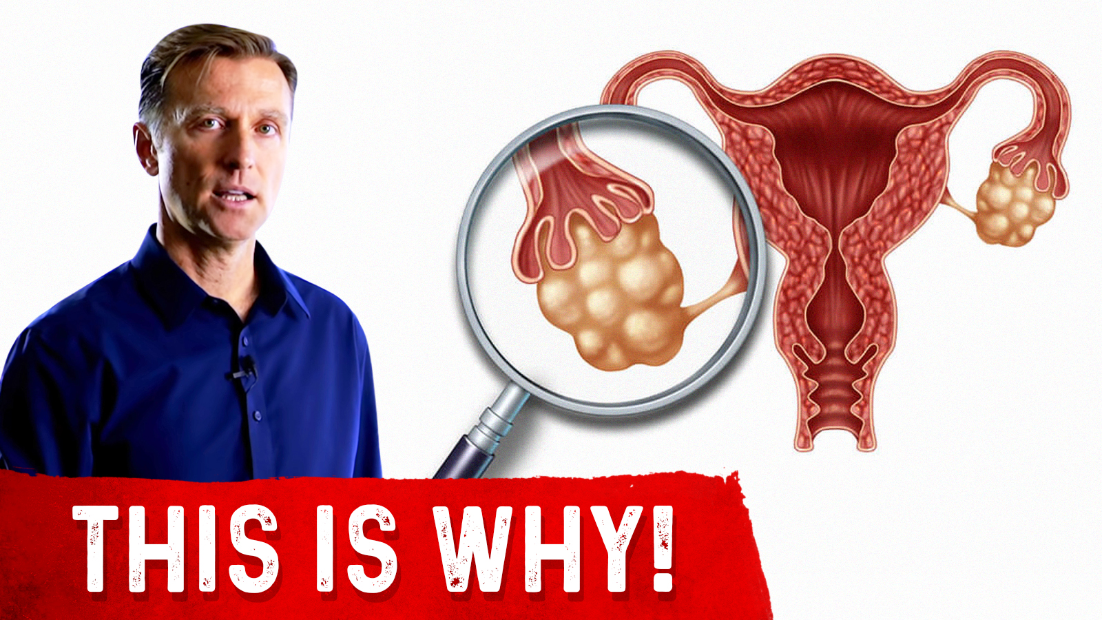 Why did I get Polycystic Ovarian Syndrome? | Healthy Keto™ Dr. Berg