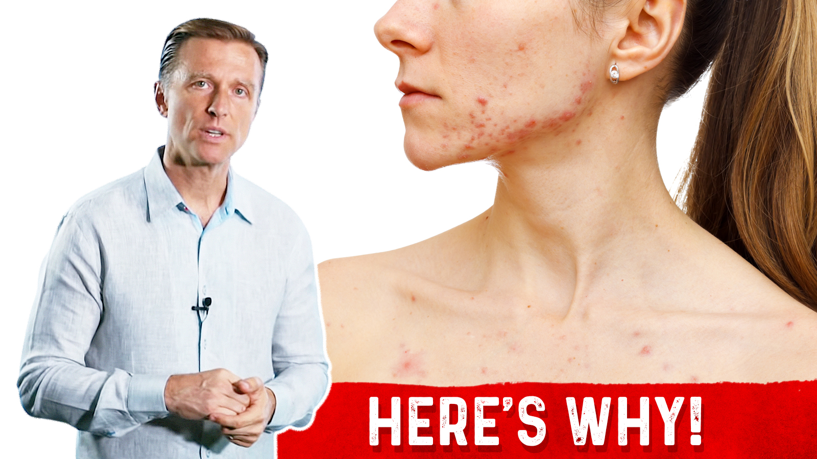 Acne During Your Period or Menstruation? Healthy Keto™ Dr. Berg