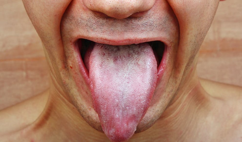 photo of a man’s tongue with white coating