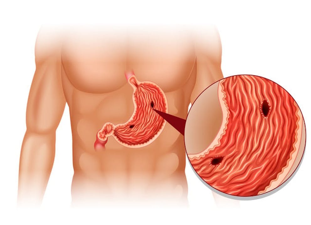 Stomach ulcer can cause iron deficiency 