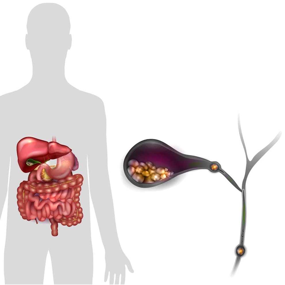 Anatomy drawings of gallbladder and liver in digestive system, with gallstones in bile ducts.