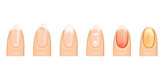 Britton's Pharmacy - 💅Tuesday Tips 💅 Suffer from Brittle Nails ? If your  nails are brittle you may have an iron deficiency, so it is recommended to  check you iron levels with