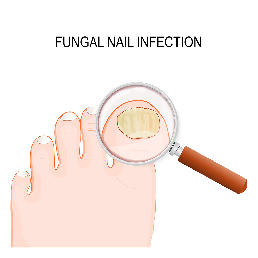 Fungal Nail Infection