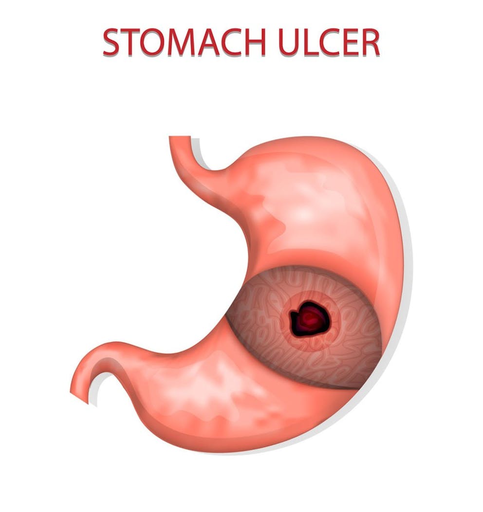 Medical illustration of stomach ulcer in stomach lining on white background.