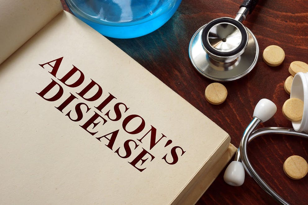 Medical book open to page that says Addison’s disease, stethoscope and pills on table in background.