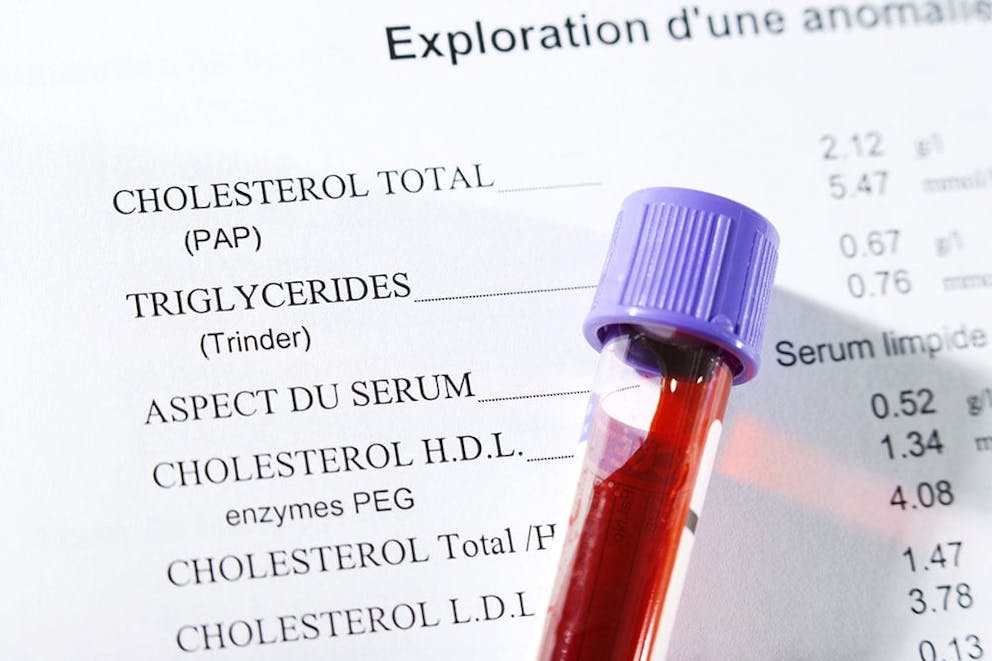 Blood test tube for cholesterol level testing, results written on paper in background.