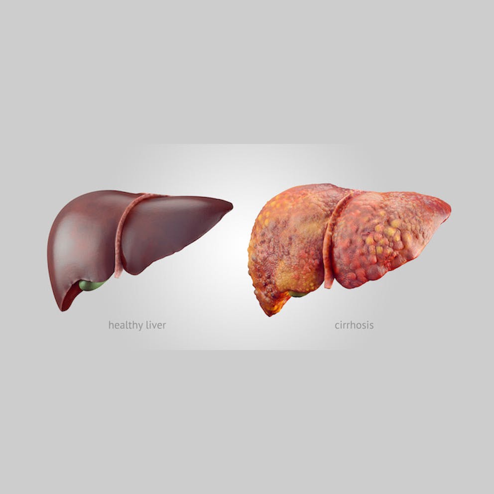 A side-by-side comparison of a healthy liver and an unhealthy liver with cirrhosis | Your Liver is Triggering Your Right-Sided Shoulder Blade Pain