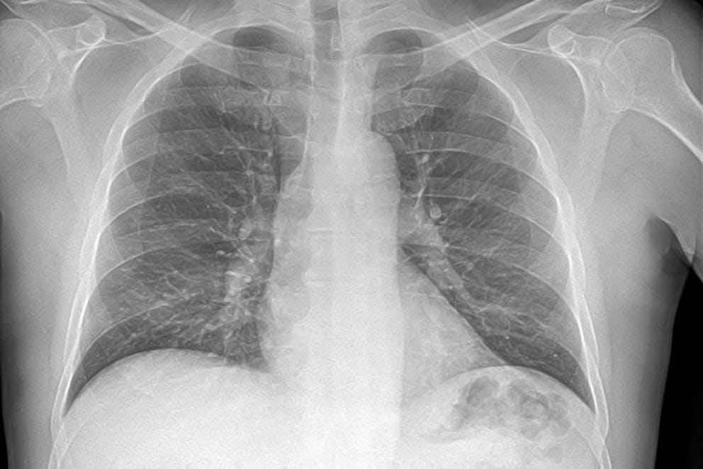 an X-ray of compromised lungs