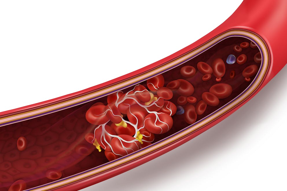 Blood clot illustration