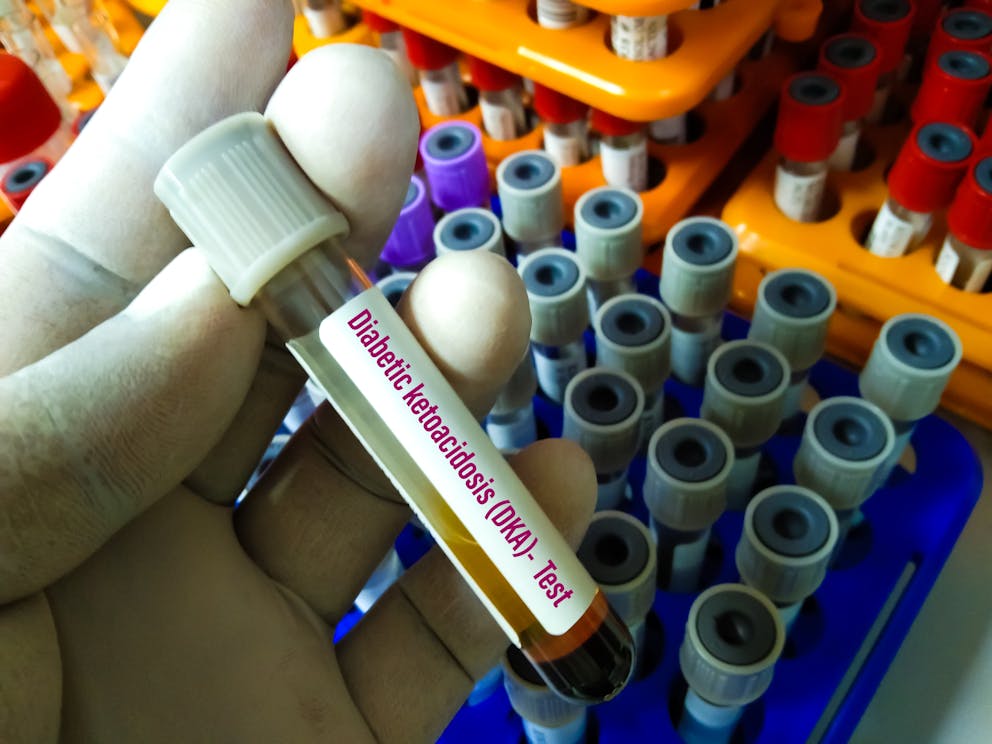 DKA blood sample