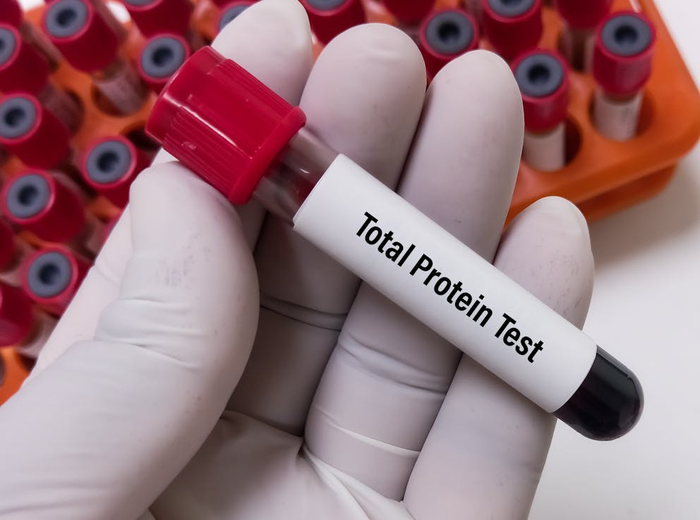 Blood protein test