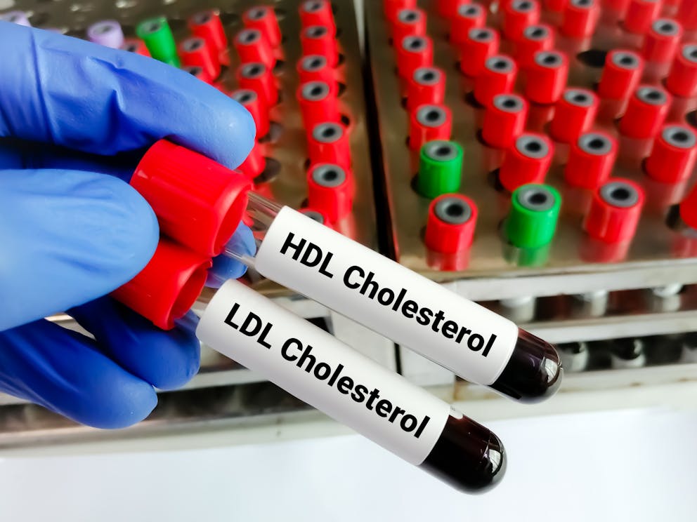 LDL and HDL cholesterol blood test