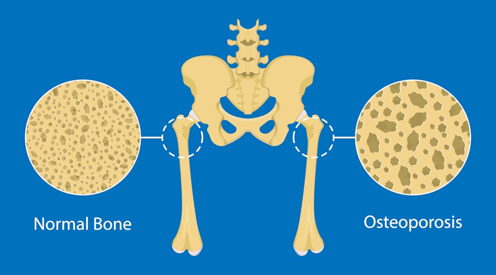 Bone mineral density (BMD) osteoporosis