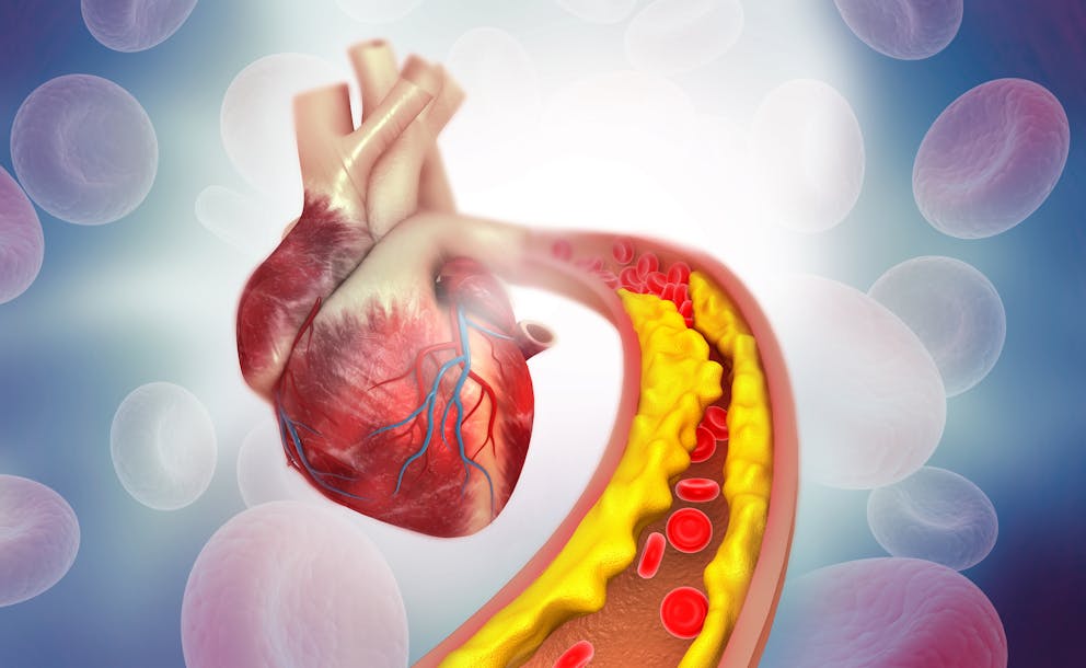 Cholesterol plaque illustration