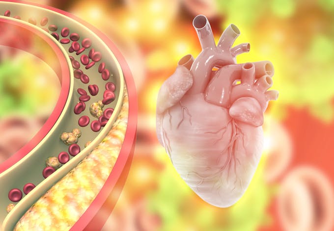 Cholesterol in arteries and heart