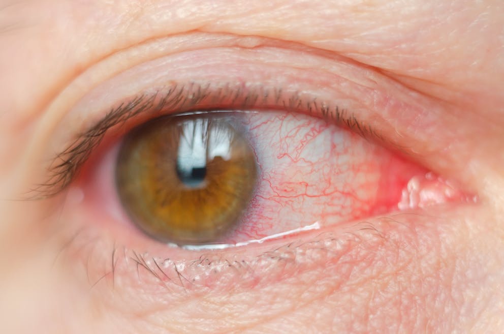 Watery eye red and inflamed