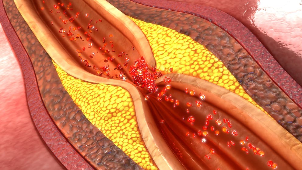 Peripheral artery disease illustration