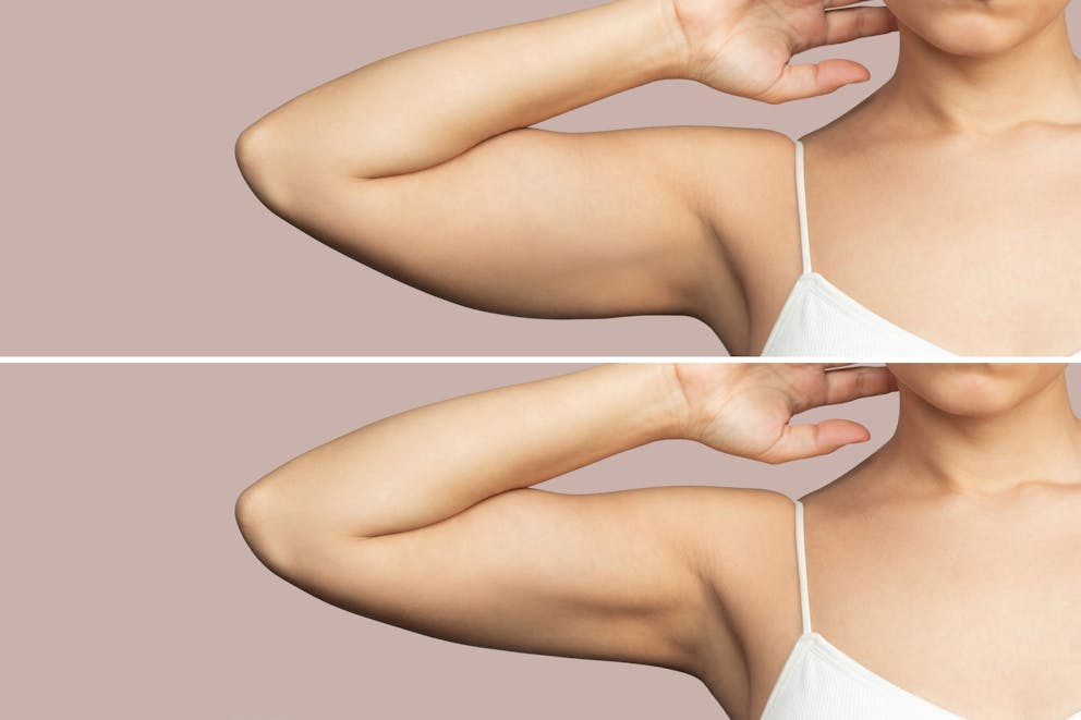 Before and after upper arm fat treatment