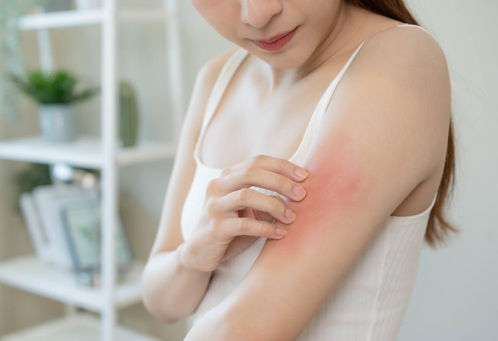 Woman with skin rash