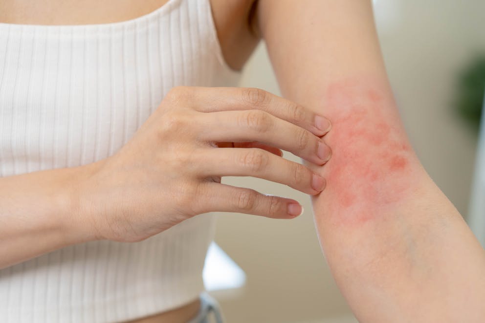 Woman with skin irritation