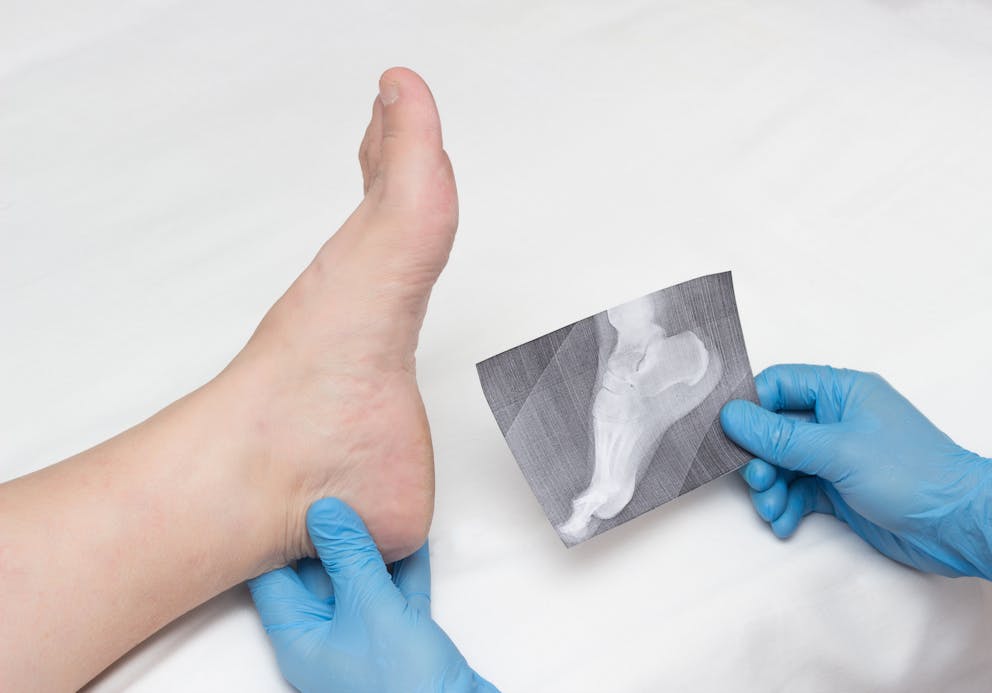 Doctor analyzing foot spur X-ray