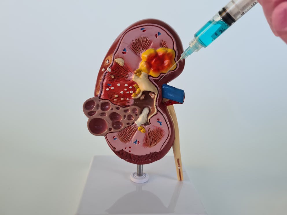 Doctor urologist makes an injection in a human kidney