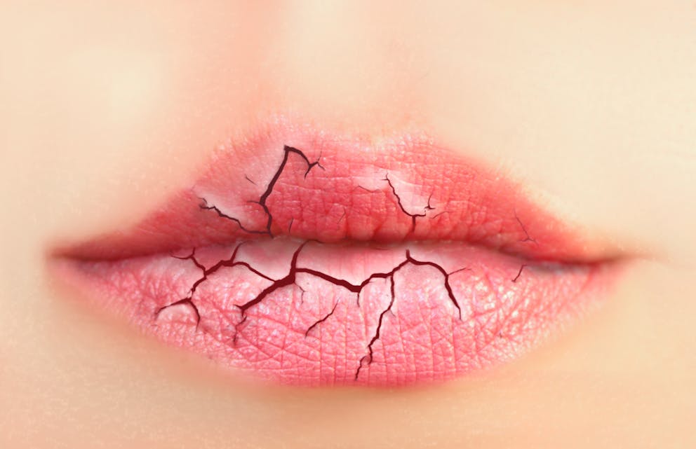 Dry lips illustration