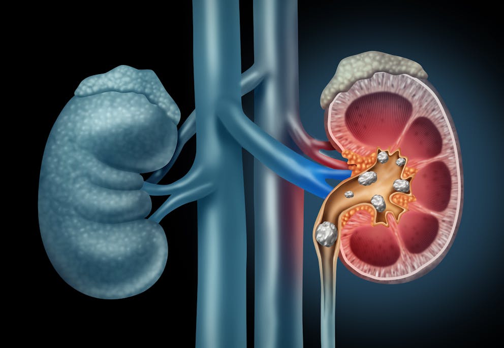 Human Kidney stones medical concept as an organ with painful mineral formations
