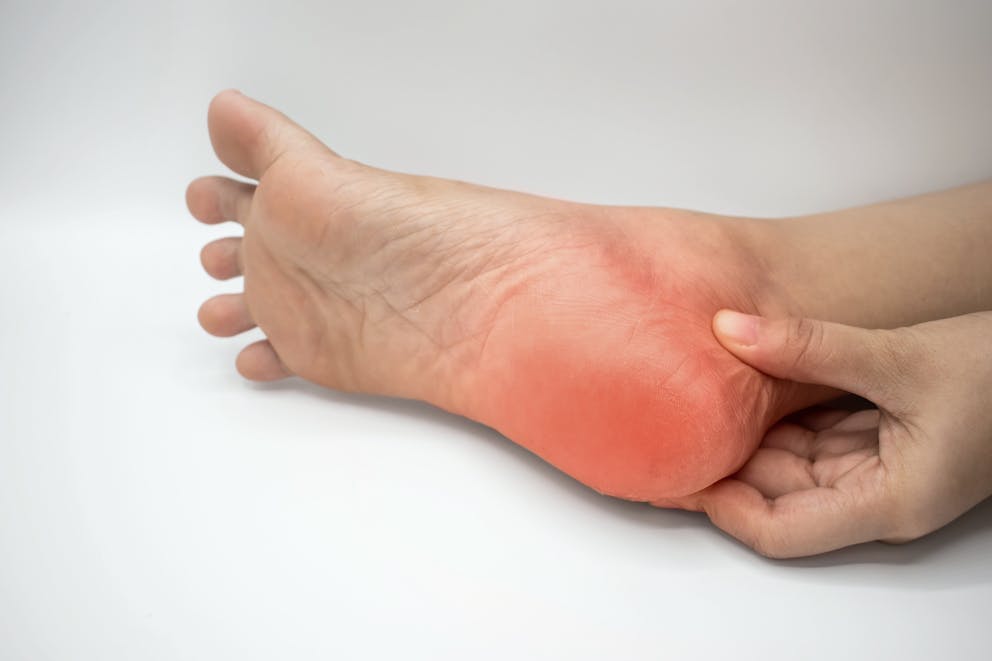 Painful foot with plantar fasciitis