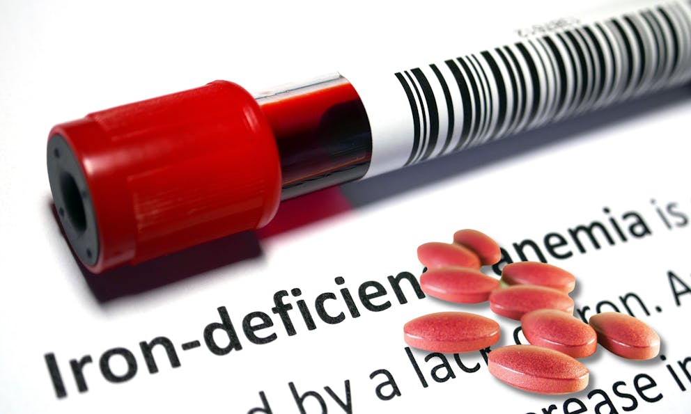 Iron deficiency anemia blood sample