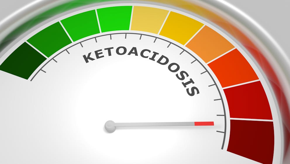 Ketoacidosis illustration