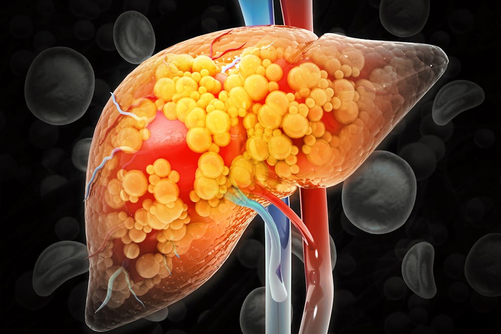 Fatty liver illustration