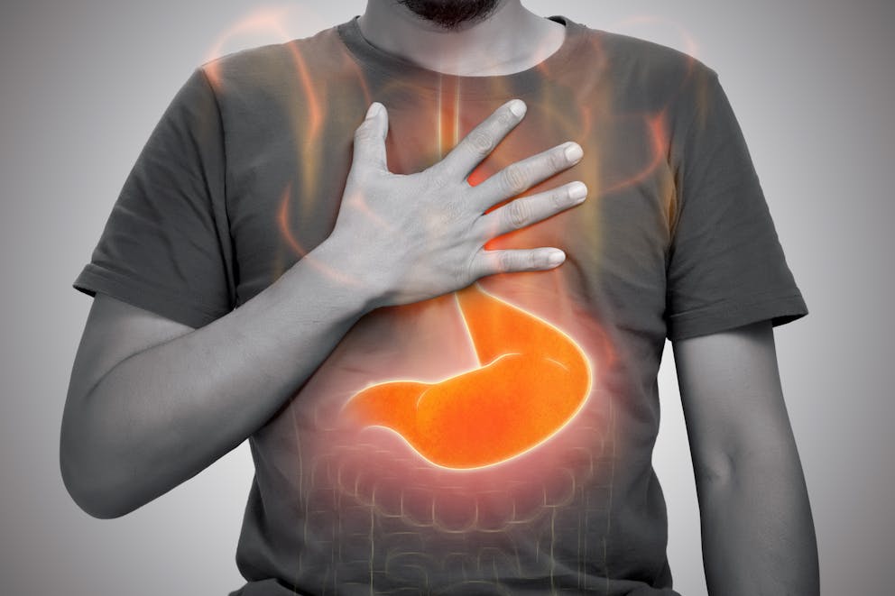 Acid reflux illustration