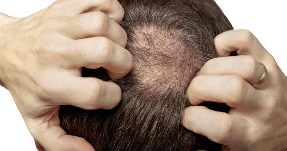 Male hair loss